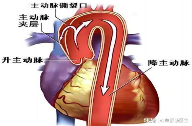 动脉硬化等三类血管病变哪个最危险 中老年需警惕