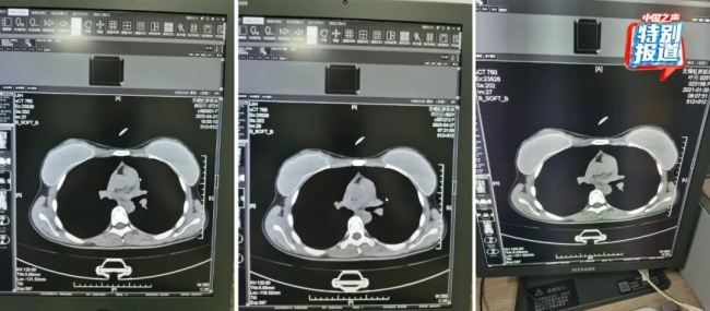 25岁、72岁、62岁三人CT片几乎一样？“无锡虹桥医院涉嫌骗保”最新进展来了→