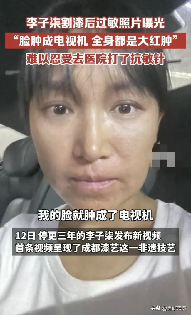 李子柒曾生漆过敏全身红肿 坚强微笑感动网友