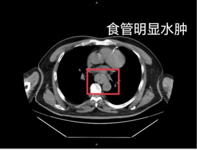 一口&quot;热辣滚烫&quot;男子吐血休克 &quot;趁热吃&quot;可能致癌