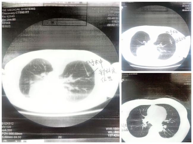 女子术后1年发现肺结节还在且已癌变 医疗失误引发争议