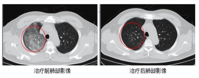 江苏确诊一例罕见传染病