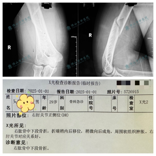 两小伙与机器人扳手腕当场骨折 游乐设施隐患需警惕