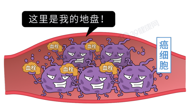 肺癌一查就到晚期？其实双腿早就给暗示，只是很多人没发现