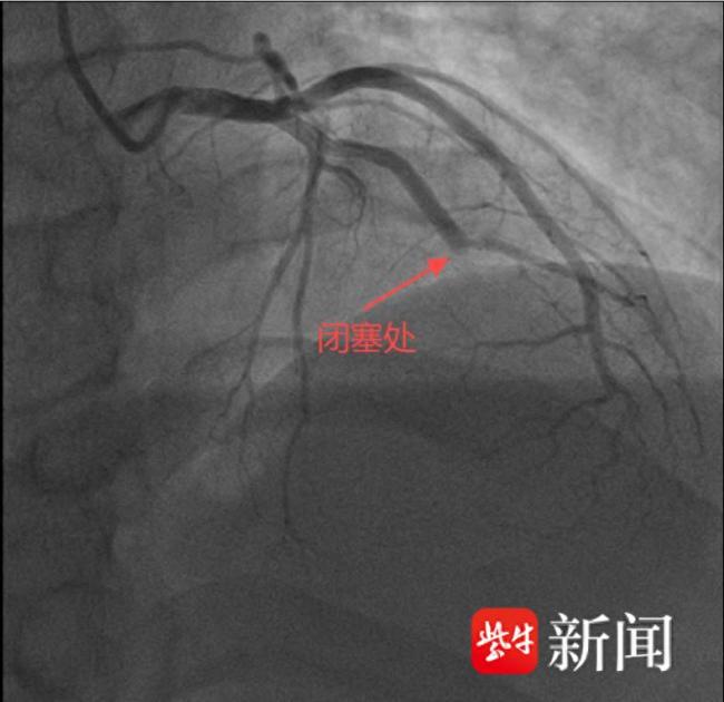   外籍患者因胸痛就醫(yī)被醫(yī)生強(qiáng)行留院