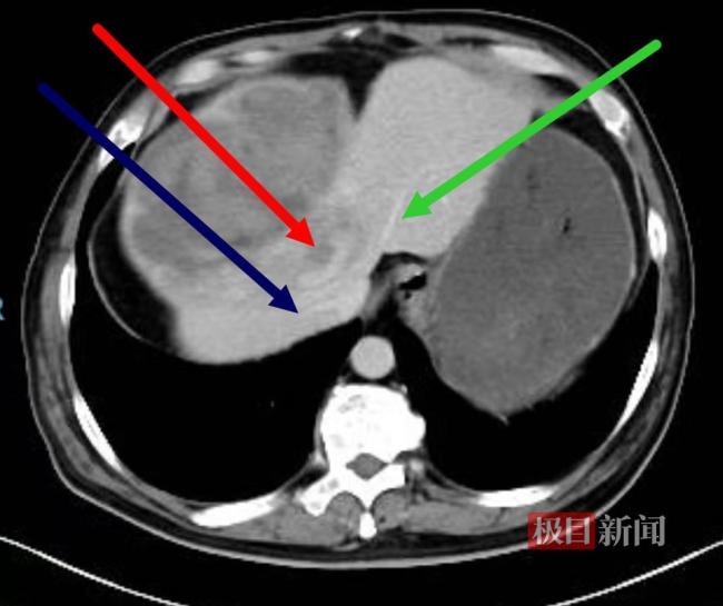 男子肝臟上藏巨大腫瘤