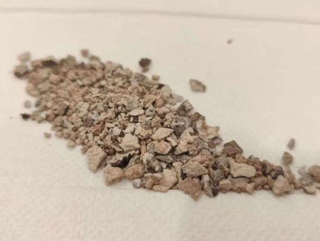 64岁大爷体内取出1791颗结石 手术团队惊呆了