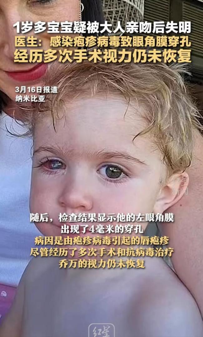 1歲多寶寶疑被大人親吻后失明