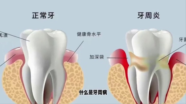 我国90%以上成年人有牙周疾病 口腔健康关乎全身健康