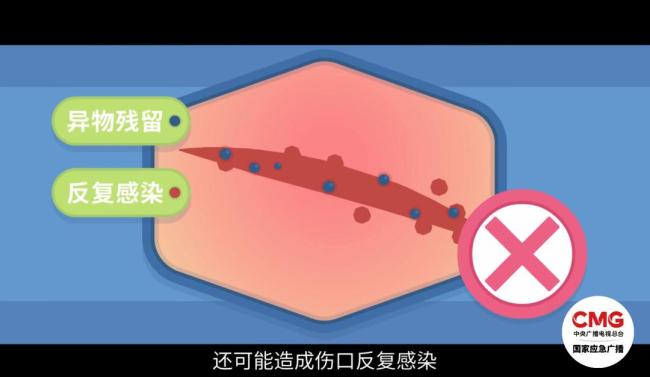 女子洗澡時(shí)因玻璃門炸裂受傷 手筋斷裂多處縫針