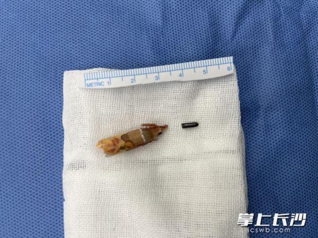 女童被鉛筆刺傷致慢性骨髓炎