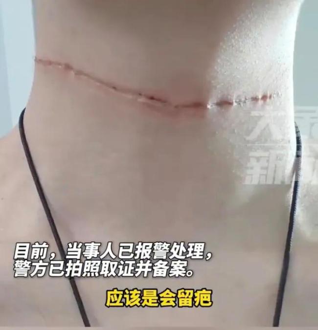 又到风筝季，2天3起“割喉”！17岁男孩被风筝线割伤脖子缝21针 春游暗藏风险