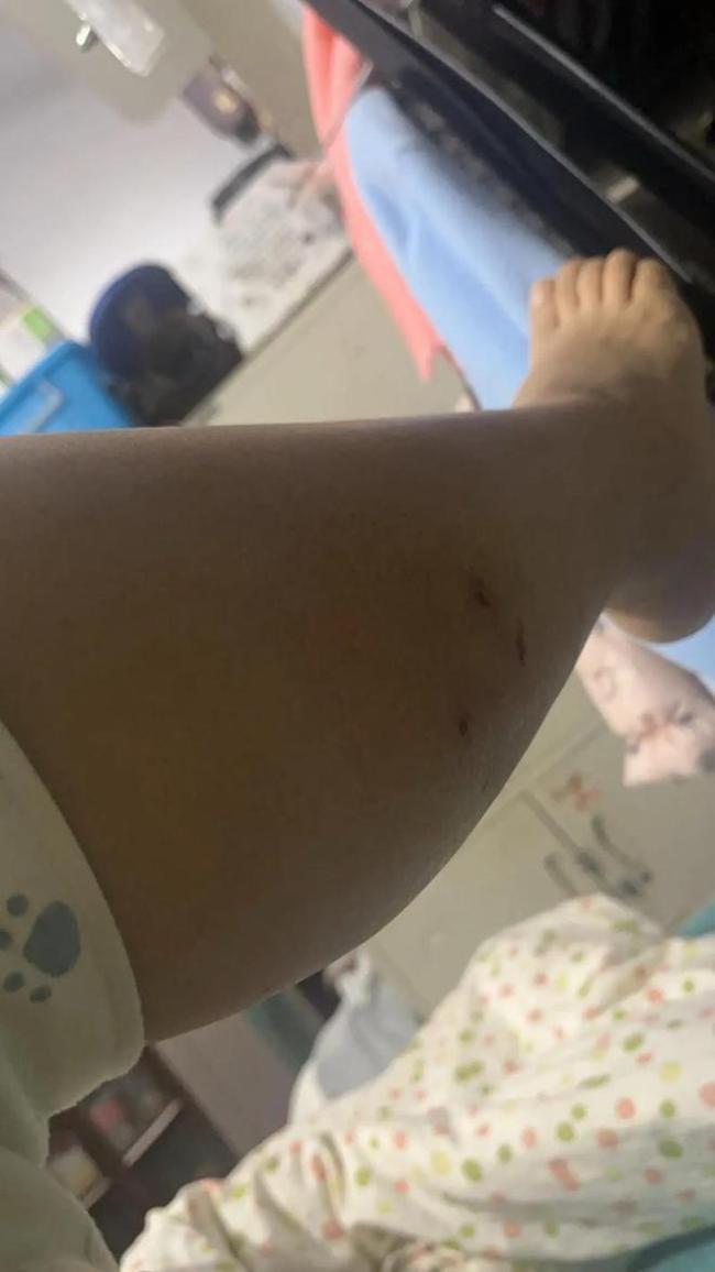 女子遭自家猫咪攻击 咬痕有17处