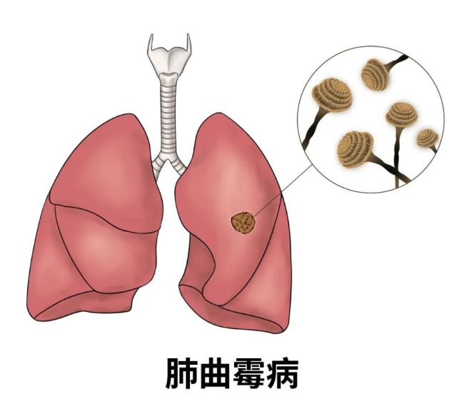 高燒40℃、肺部“發(fā)霉”,，只因忽略一個(gè)細(xì)節(jié),！
