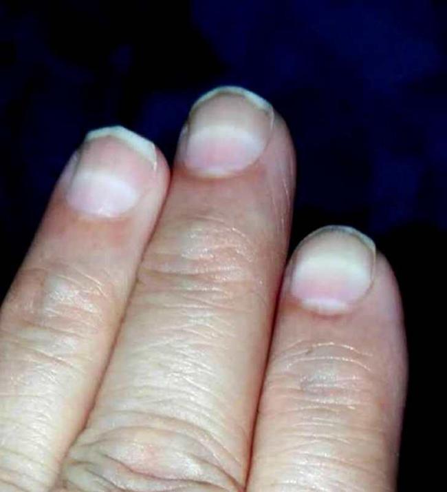 3歲女童突然脫發(fā)查出鉈中毒 鉈中毒癥狀及治療解析