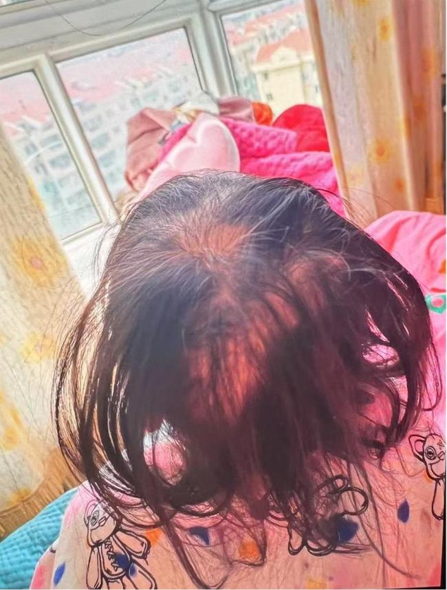 3歲女童查出急性鉈中毒 罕見病例引關(guān)注