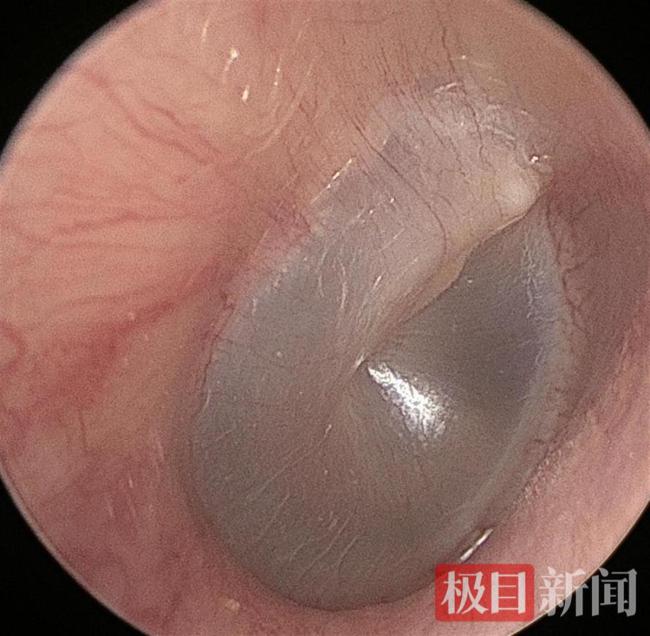 男子長期和貓同睡耳中長出貓螨蟲 寵物共眠需謹(jǐn)慎