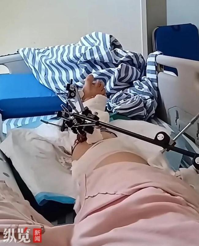 女子墜樓向丈夫喊我還沒(méi)死快打120 奇跡生還待二次手術(shù)