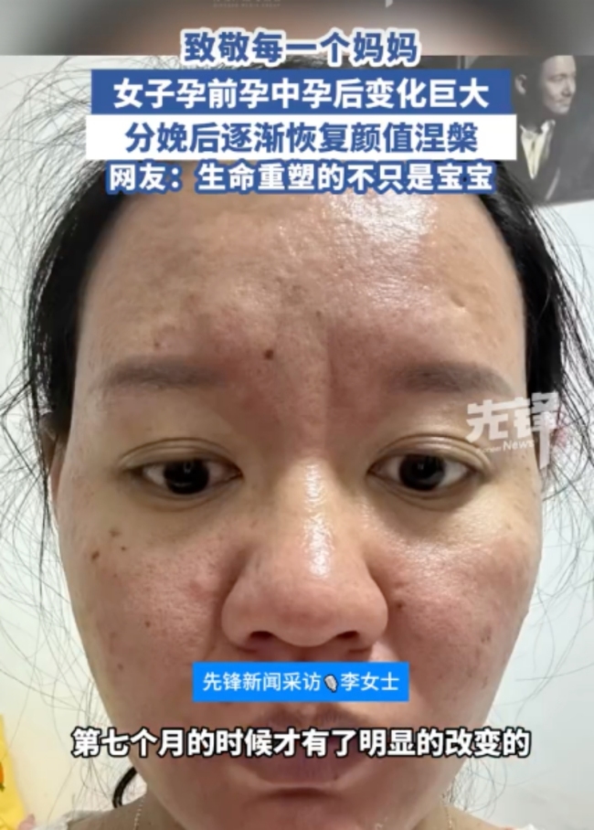 女子分享孕中孕晚分娩后容貌變化 孕激素下的變形記