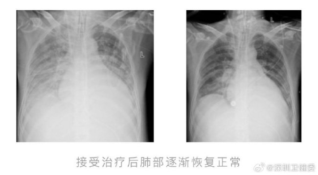 小伙高燒不退肺被“燒白”進(jìn)ICU,，感染超級(jí)耐藥菌差點(diǎn)沒(méi)命,！