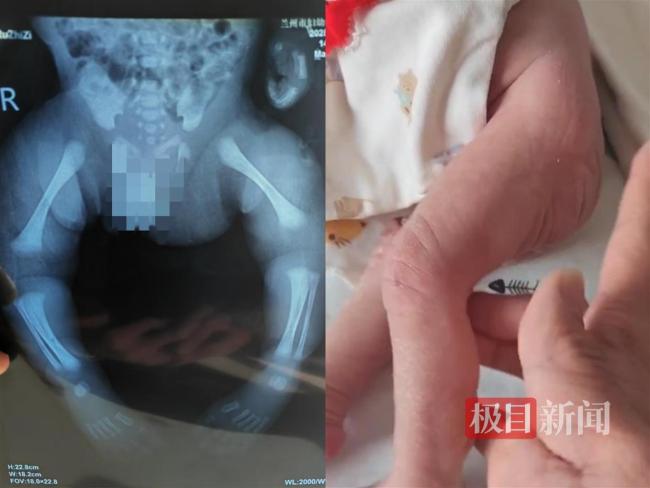 殘疾夫妻二胎患先天病 懷疑產(chǎn)檢漏檢 高風(fēng)險孕婦未獲針對性檢查