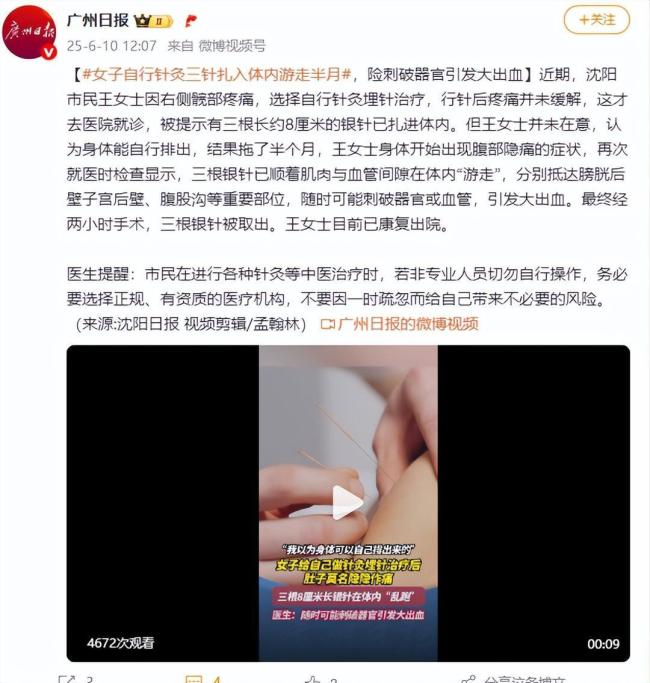 女子自行针灸3针扎入体内游走半月