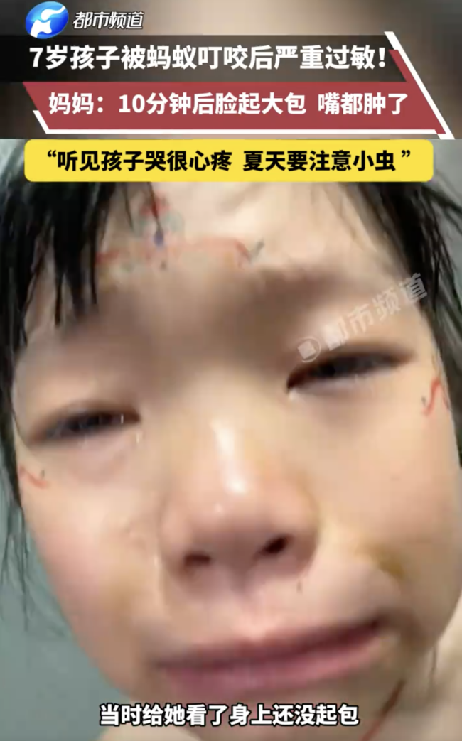 小孩姐被螞蟻叮咬后滿臉大包