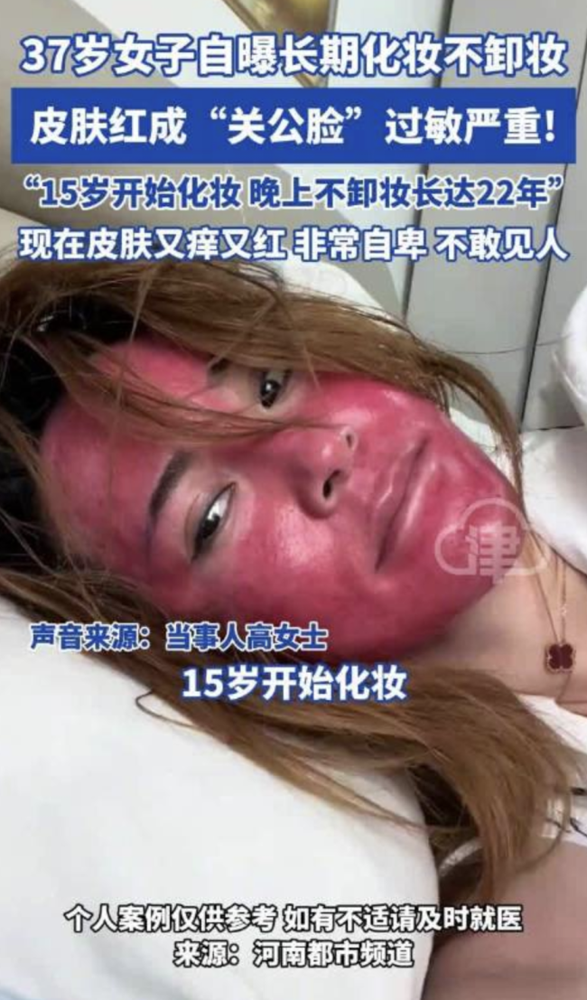 女子回應22年化妝不卸妝過敏,！