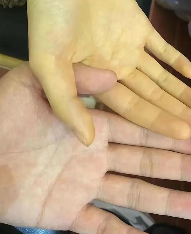 吃了一包堅(jiān)果,，5歲孩子住進(jìn)ICU,，此病南方高發(fā) 警惕“蠶豆病”