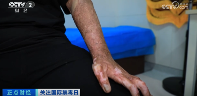 18岁少年全身严重烧伤 只因和朋友“上劲”玩这个
