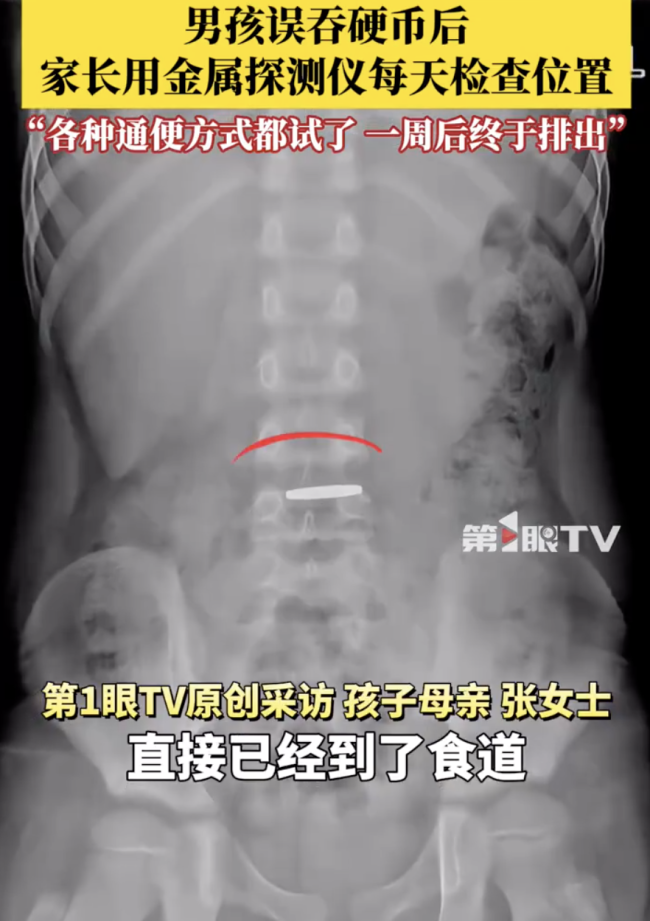 男孩誤吞硬幣家長用探測儀檢查位置