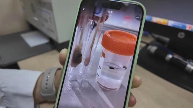 小伙脖子腫痛開刀取出7顆瓜子 罕見病梨狀窩瘺作祟