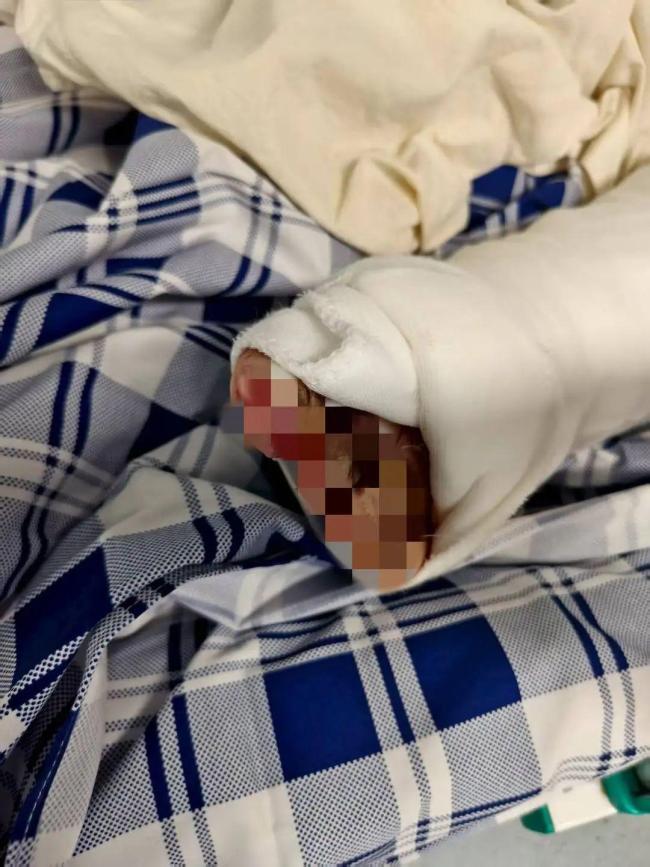 男子幫鄰居關煤氣遇閃爆 英勇行為致全身嚴重燒傷