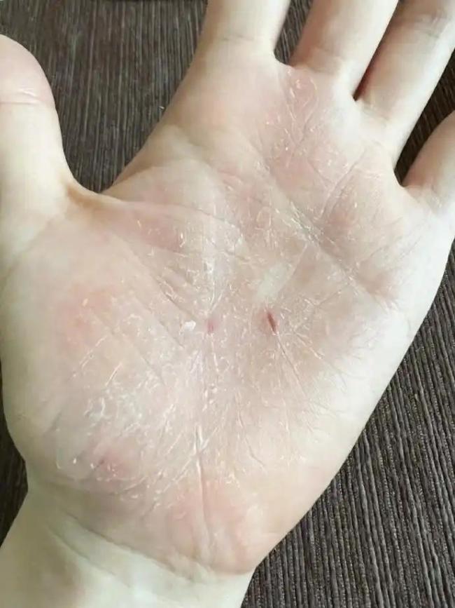 张靓颖自曝患病 伸懒腰手掌流血十年