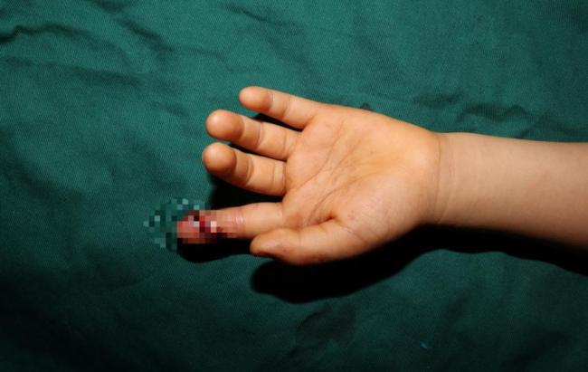 5小时跨城 “断指营救”！7岁男童指尖成功再植