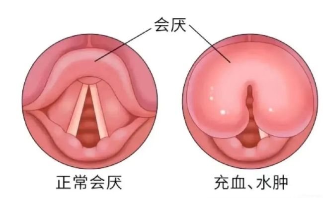 男子“刀片嗓”硬扛差点丧命 医生警告：不是感冒
