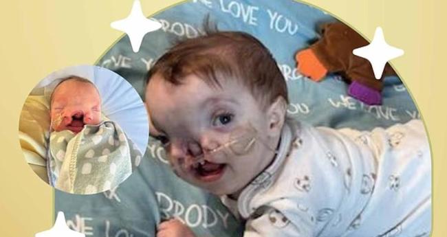 美国一名婴儿出生时脸部裂开 月底即将满周岁时接受手术