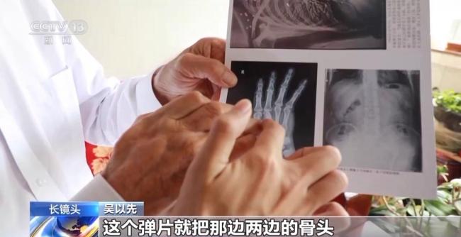 33个弹片成为老兵摘不掉的“项链” 一段不平凡的往事