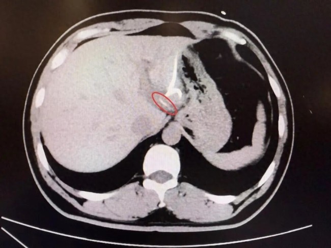 男子誤吞魚刺穿透胃壁“鉆”入肝臟！
