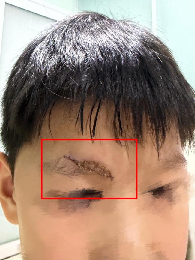 男童游乐场摔伤 家长索祛疤费遭拒