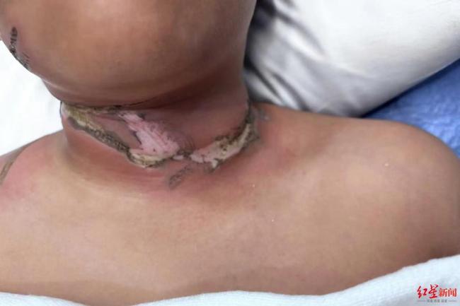 美国9岁男孩睡梦中严重烧伤 项链触电引发火灾