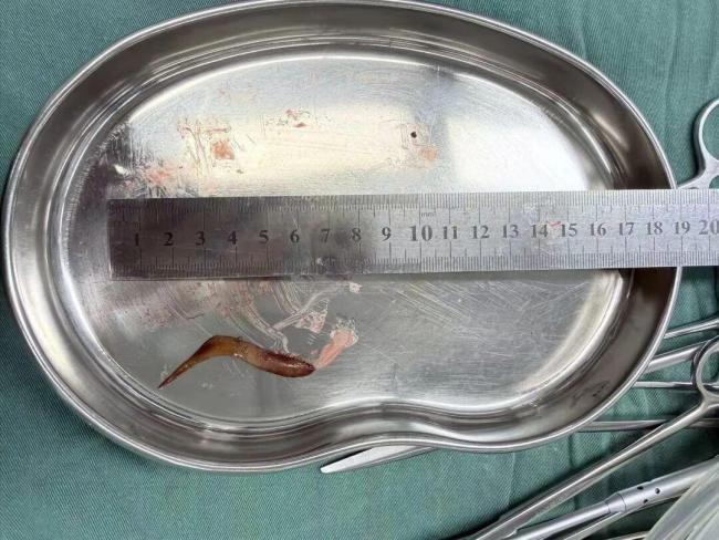 男子误吞甲鱼骨 自救致腹腔感染 米饭“自救”酿大祸