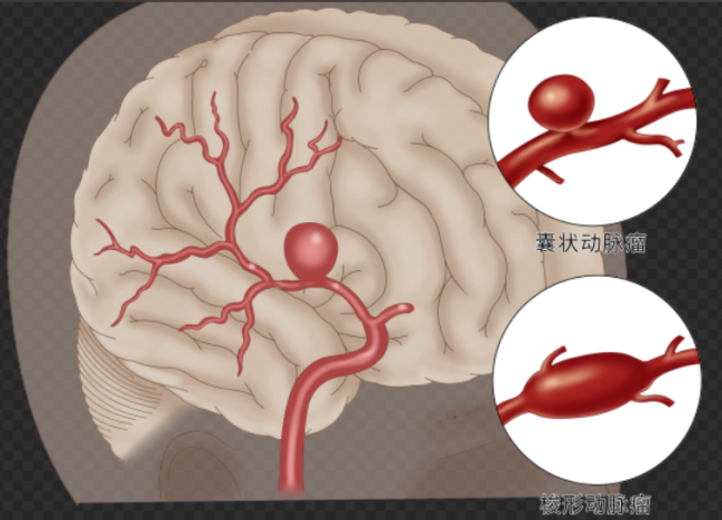 女子突然头痛呕吐送医确诊脑出血 警惕脑动脉瘤破裂