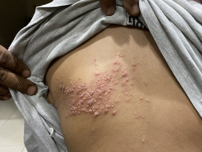 斯坦福研究：几乎人人携带的这种常见病毒，是红斑狼疮元凶