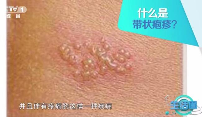 帶狀皰疹發(fā)病的主要原因 免疫力下降引關(guān)注