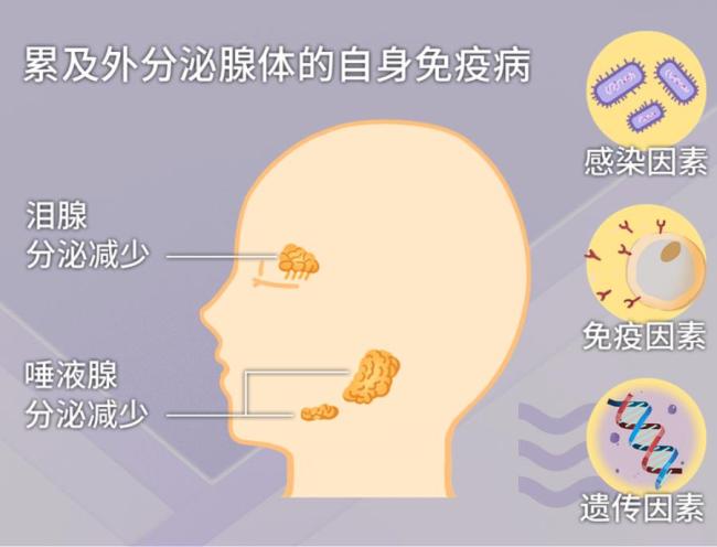 总是干燥？小心干燥综合症