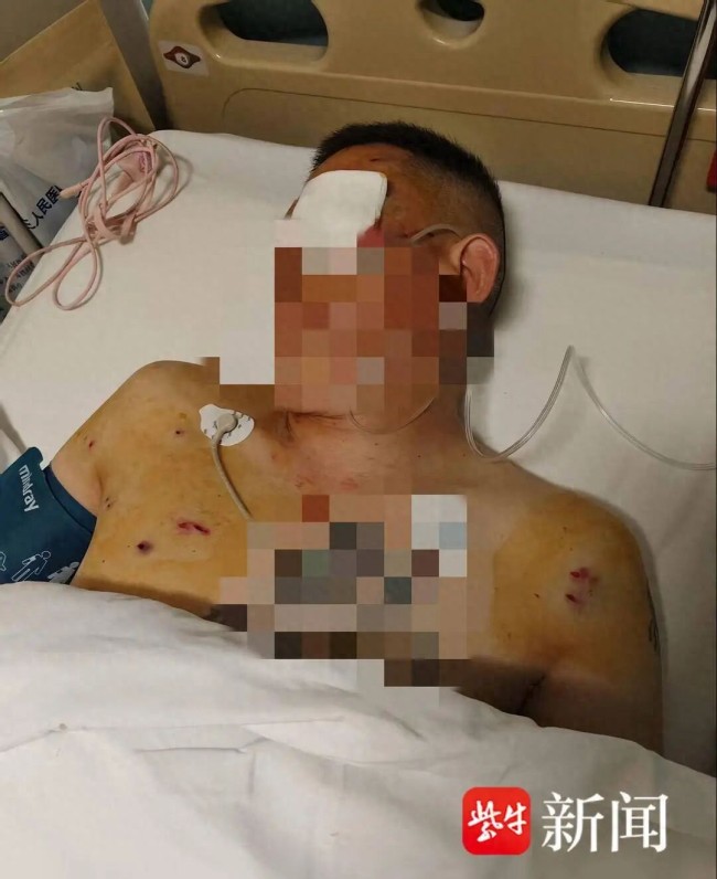 男子取170万现金被抢致重伤左眼失明 银行安保引争议