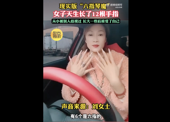 女子長12根手指自稱靈活好用 悅納不同活出精彩