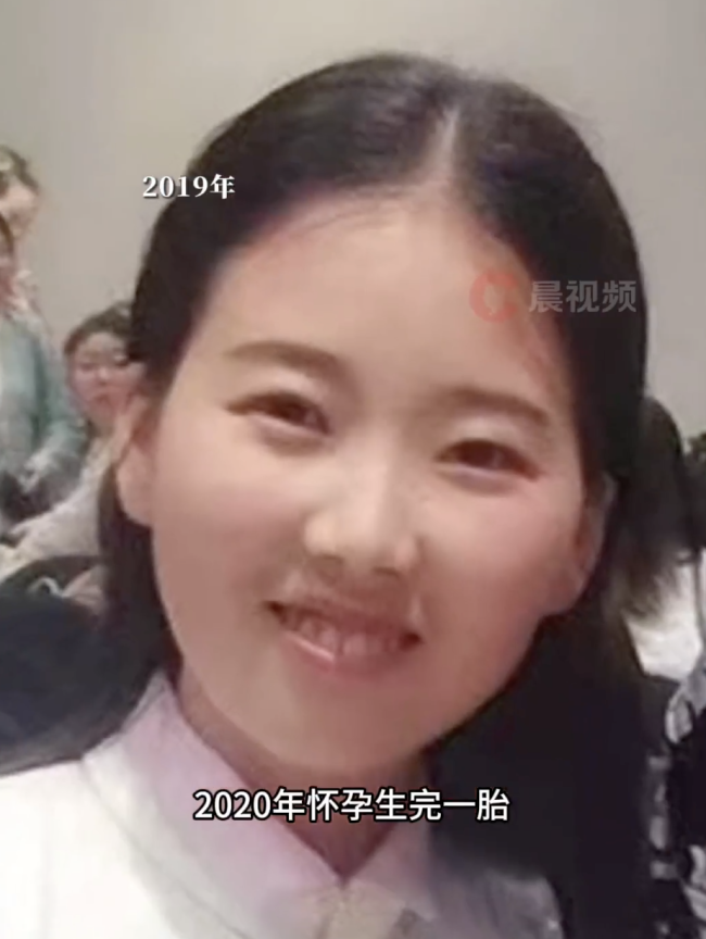 36歲寶媽生完二胎后患上嚴重牙周病