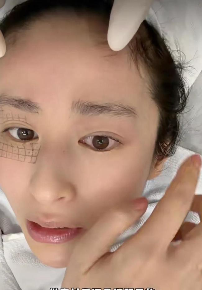 颖儿做眼部热玛吉疼哭了 明星的美丽代价